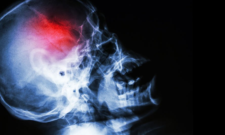 bronx brain injury lawyer