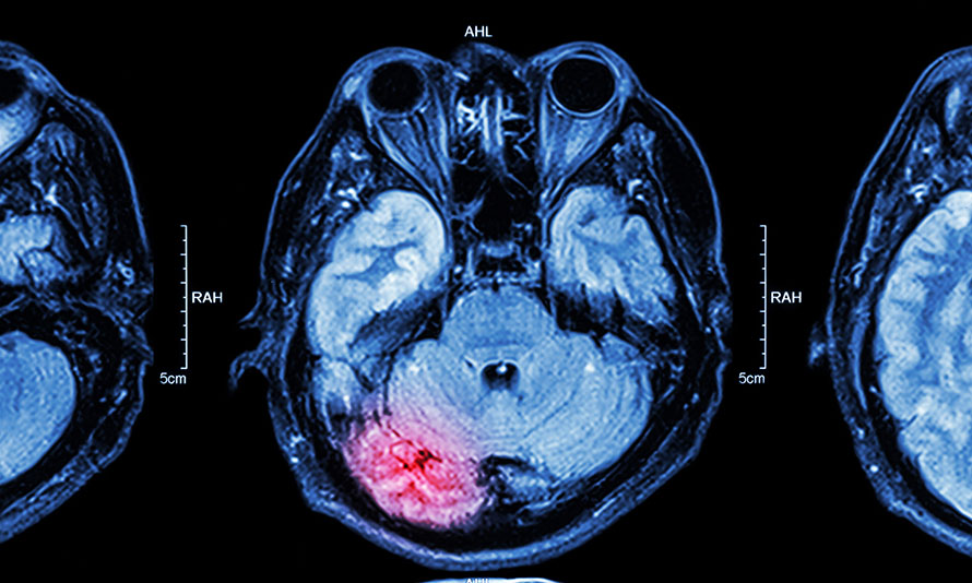 brooklyn brain injury lawyer mri